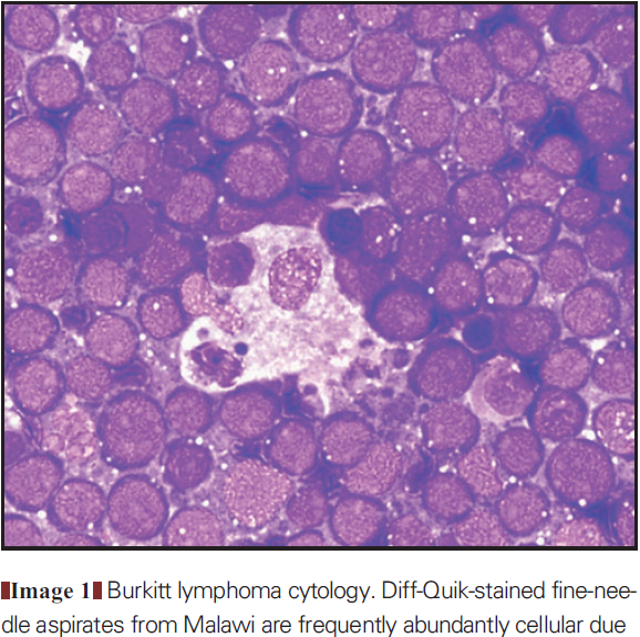 Burkitt lymphoma cytology